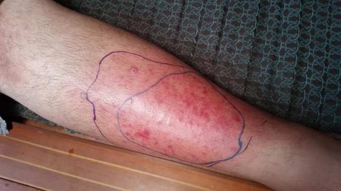 A man's leg with a painful red infection on the shin